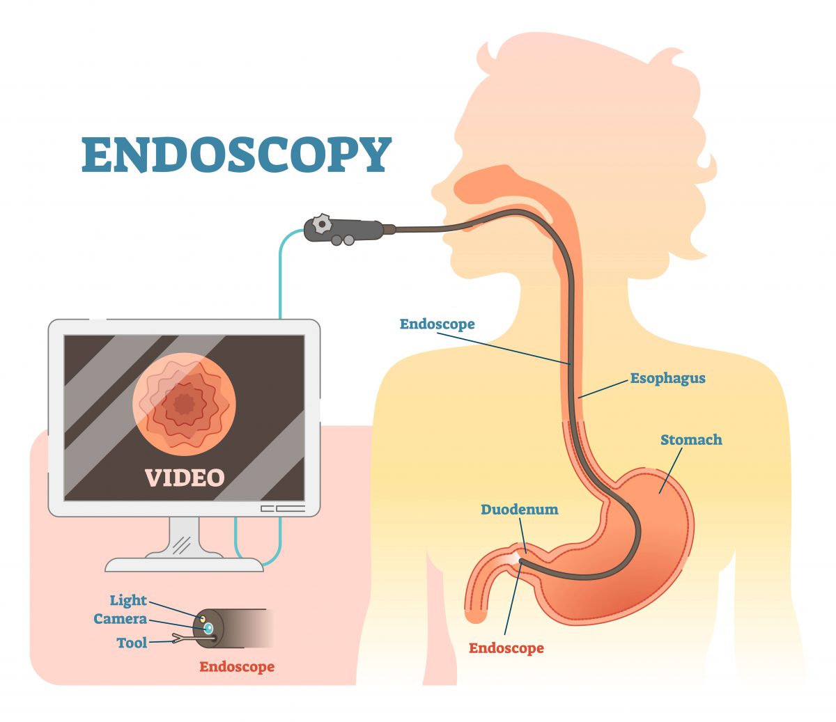 after effects endoscopy