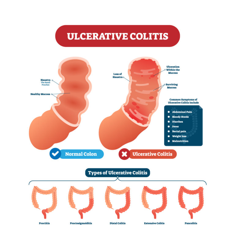 Ulcerative Colitis Treatment | Dr Ong Paediatrician & Gastroenterologist